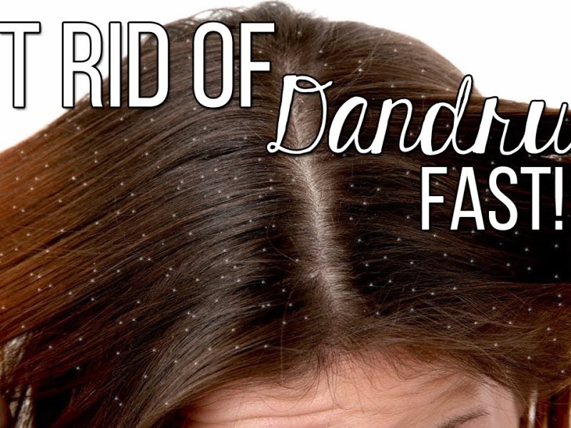 How to Get Rid of Dandruff – Causes, Treatments, and Prevention